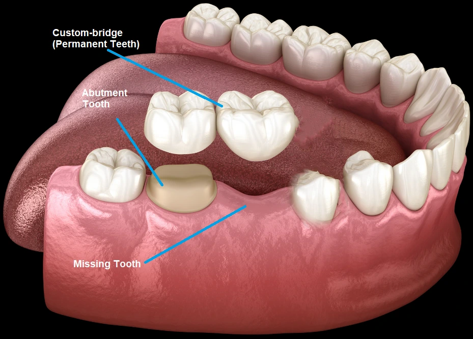 Cantilever Bridge Dental
