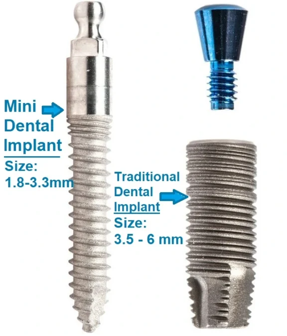 Mini Dental Implants Screw