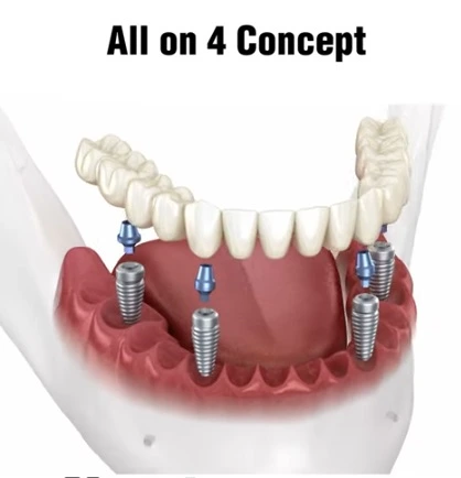 All-on-4 Implants