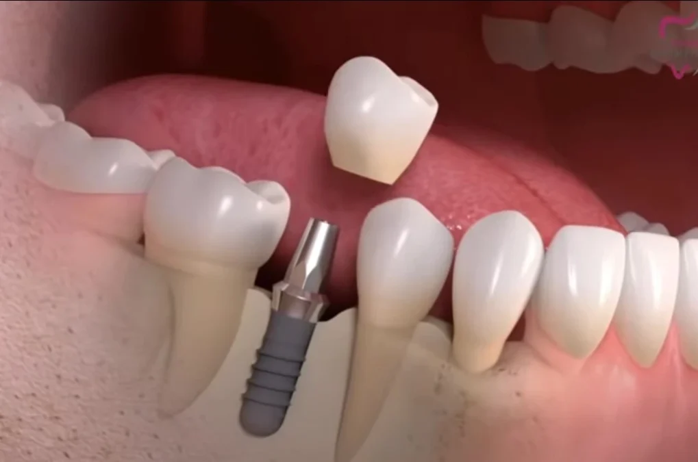 Single-Tooth Implant