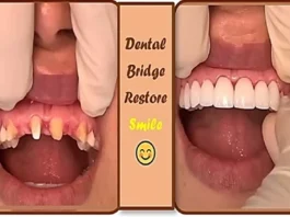 Dental Bridge Procedure