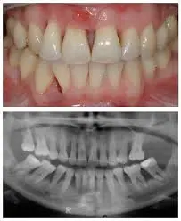 Hidden Bone Loss