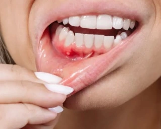 Gum Disease leading to Tooth Loss